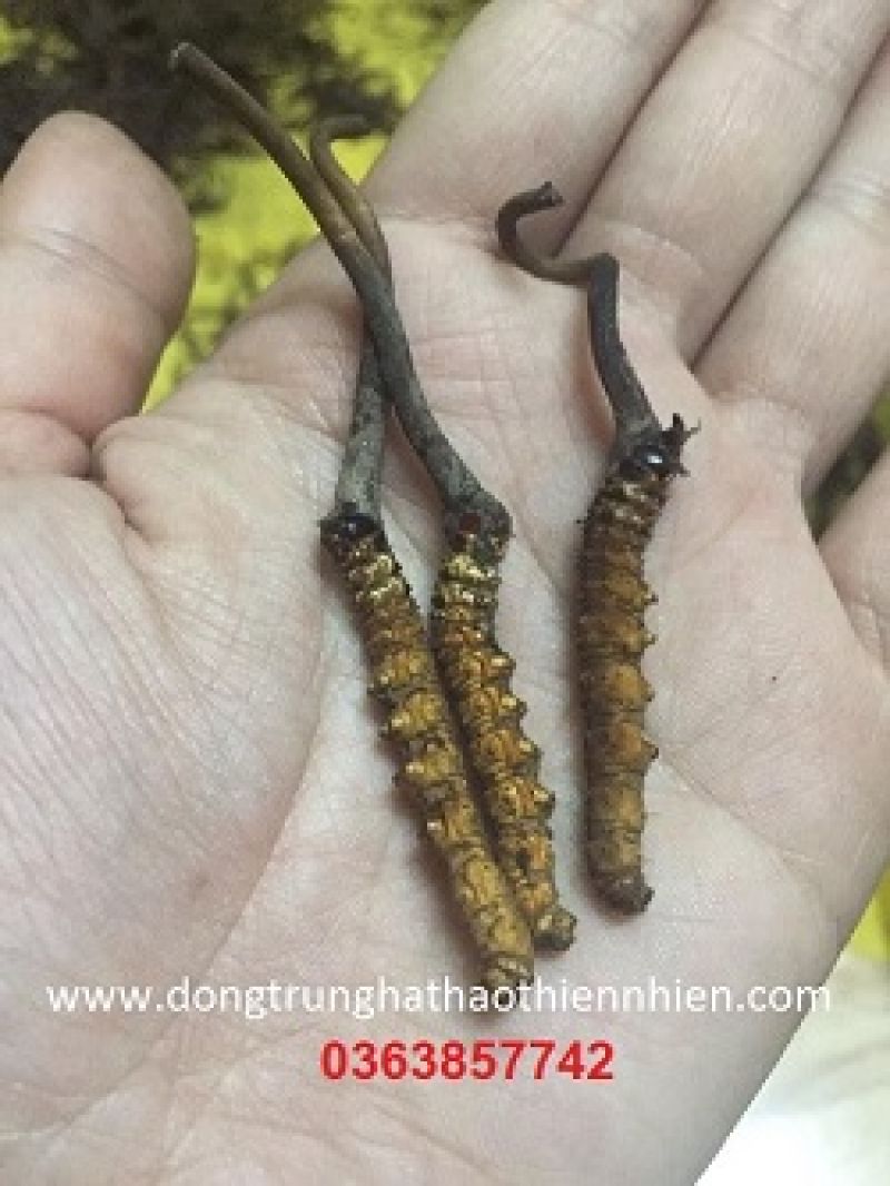 Bé trai nuốt đinh vít dài 5 cm