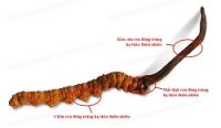 Biến chứng đái tháo đường có thể ập đến rất sớm